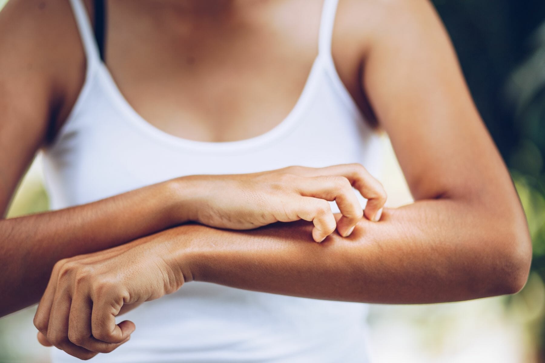 Young women hand scratch the itch on the arm, healthcare and med Young women hand scratch the itch on the arm, healthcare and med